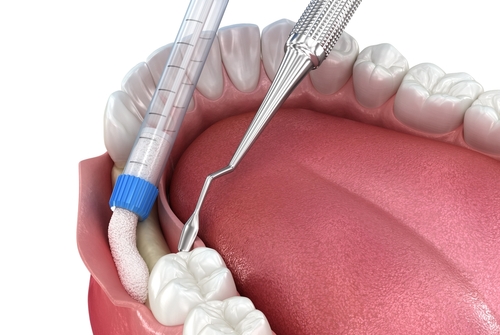 bone grafting from our dentist near you