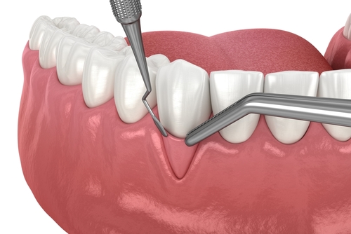 soft tissue grafting