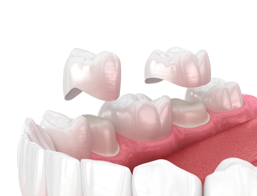 porcelain dental crowns near you