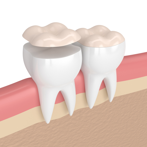 dental inlays and onlays near you